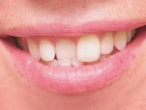 Dientes encimados