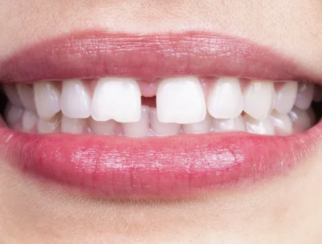 Dientes separados
